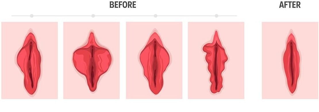vaginal-rejuvenation-treatments-Dr-Shetal-Agarwal