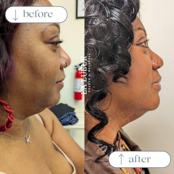 Beige White Minimalist Beauty Skincare Before After Collage Instagram Post